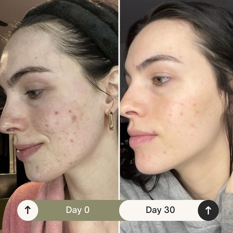 Before and after results using emerginC for 30 days