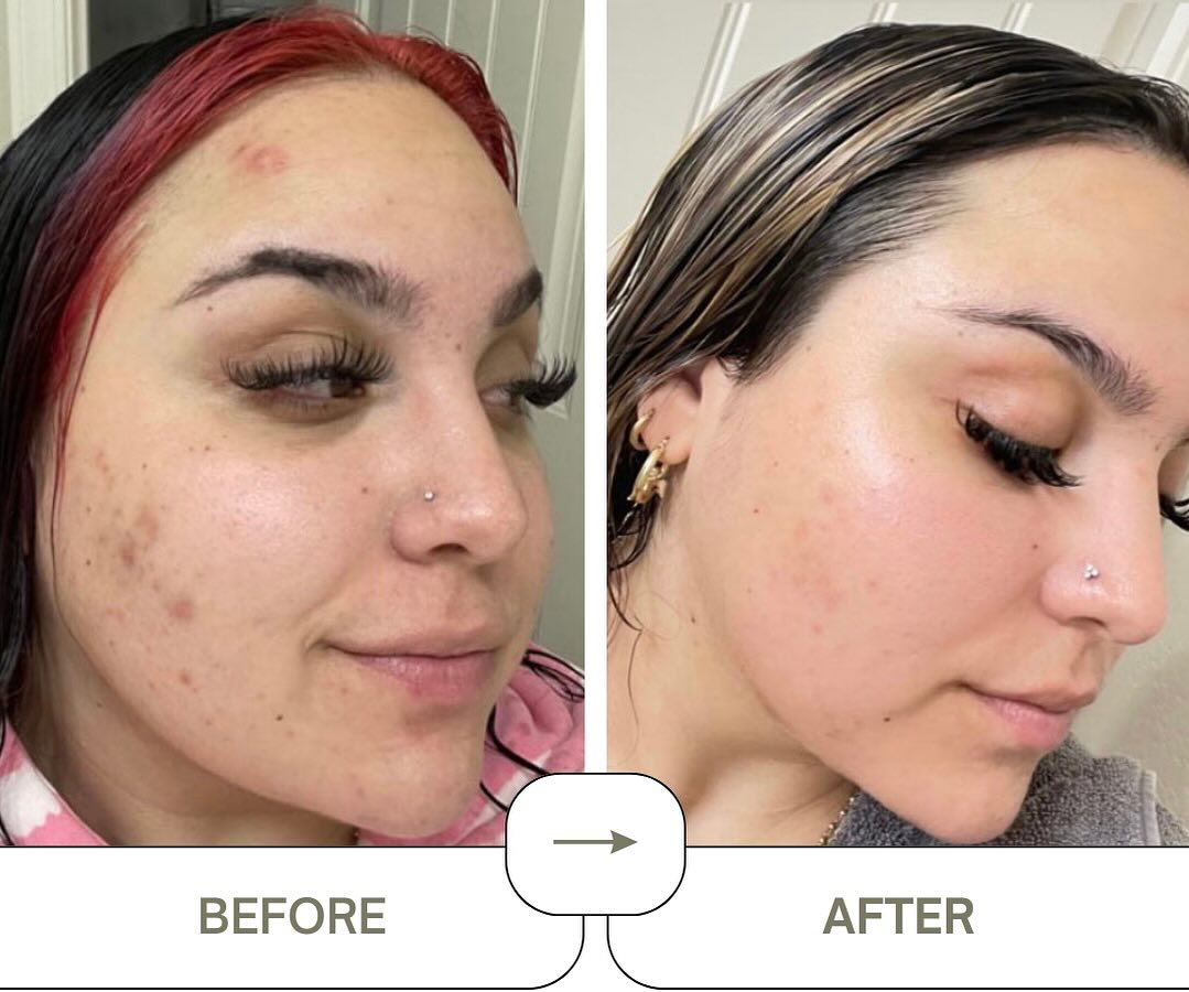 emerginC results Blue Poppy Enzyme Polish, Aromatic Cream Tea Cleanser Vitamin C Retinol Mask and Glow Guard.