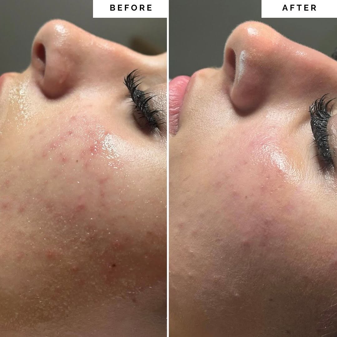 emerginC results Deglazing Cleanser and Toner, Mandelic Acid Peel, Fast Extract Step 1 and 2, Vitamin C and Retinol Mask, Vitamin C Serum, Complexion Control Cream.