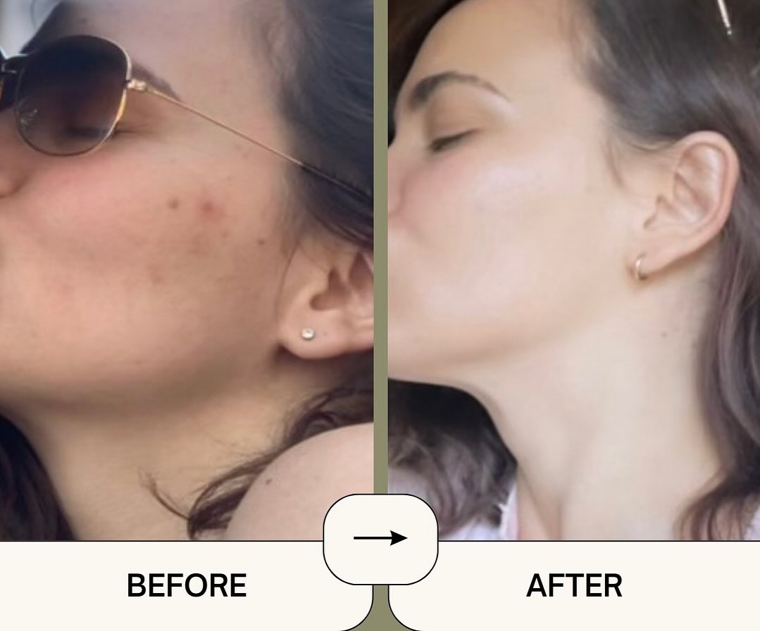 emerginC results Multi-Fruit Cleanser, Vitamin C Serum, Blue Poppy Enzyme Polish 2x week, At-Home Facial Peel Clarifying Kit 2x week, Peach Toner Vitamin C and Retinol Mask, Earth Cream.